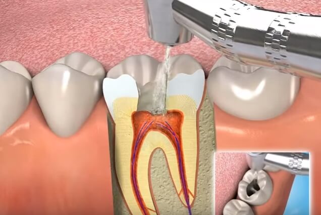 Endodonti/Kanal Tedavi